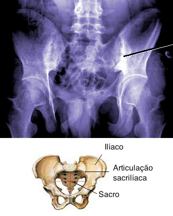 Ministro Joaquim Barbosa tem um problema reumatológico na coluna: a Sarcroileíte