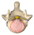 Coluna com Hérnia de Disco.