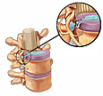 Hérnia de Disco